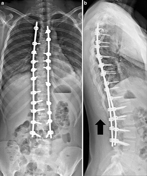 Posterior Spinal Fusion And Instrumentation Show Two Spinal Rods And Segmental Pedicular Screws