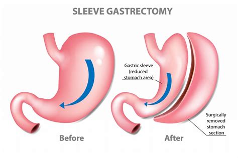 Gastric Sleeve Surgery St Louis Starting At 11111