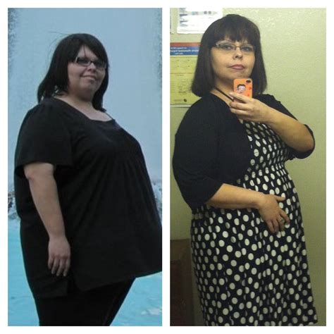 Pin On Before And After Pictures My Journey After Gastric Bypass Surgery