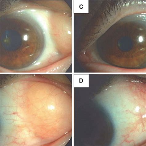 Pdf Surgical Repair Of Orbital Fat Prolapse By Conjunctival Fixation