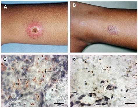 Macroscopic And Microscopic Aspects Of Active Lesion And Scar Of
