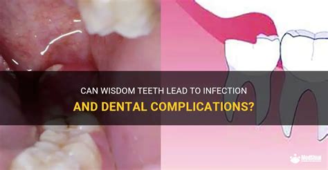 Can Wisdom Teeth Lead To Infection And Dental Complications Medshun