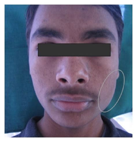 Diffuse Swelling At The Angle Of Left Side Of Mandible Download