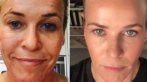 Chelsea Handler Before And After Profractional Laser