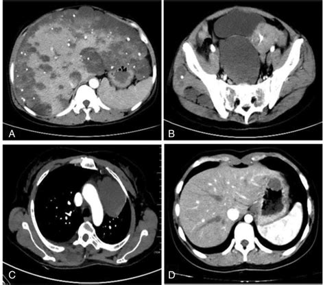 Abdomen Ct Scan With Intravenous Contrast Administration Revealed