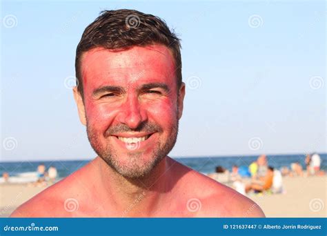 Man Smiling While Getting Sunburned Stock Image Image Of Damaged