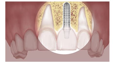 Bone Grafting And Sinus Lift The Dental Implant Guide