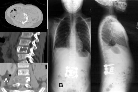 Primary Aneurysmal Bone Cyst Of The Spine In Children Updated Outcomes