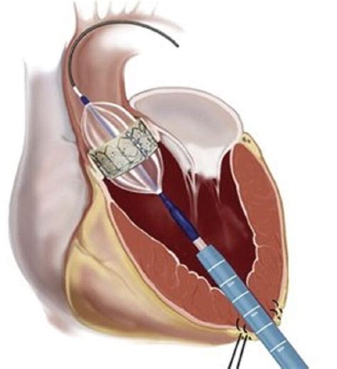 Transcatheter Aortic Valve Replacement Is Safe Effective For Very