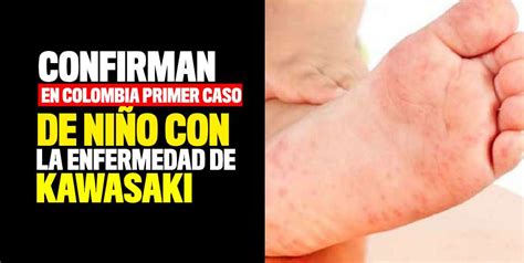 Confirman En Colombia Primer Caso De Niño Con Enfermedad De Kawasaki