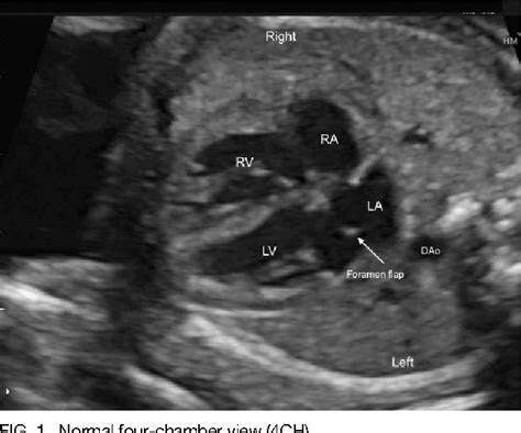 Figure 1 Congenital Heart Disease Ultrasound Obstetrics And Gynaecology