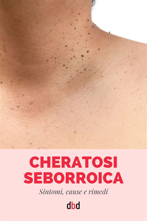 Cheratosi Seborroica Sintomi Cause E Rimedi Artofit