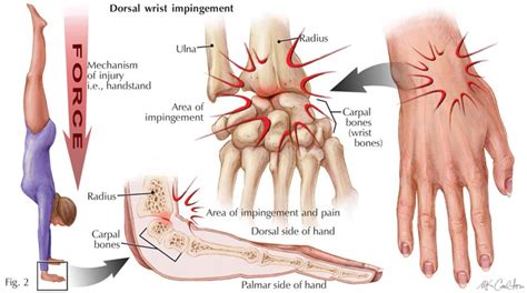 Wrist Pain Causes Symptoms Treatment Wrist Pain