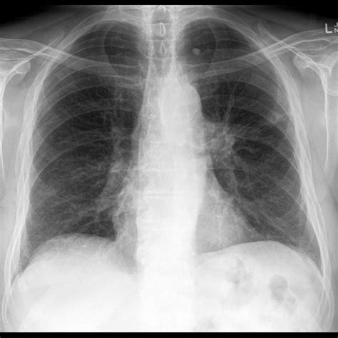 During this period you can improve your dog's quality of life by providing extra comfort and affection. Metastatic Lung Cancer. Causes, symptoms, treatment ...
