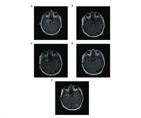 Complete Response Of 2 Asymptomatic Brain Metastases In Patient Case Download Scientific