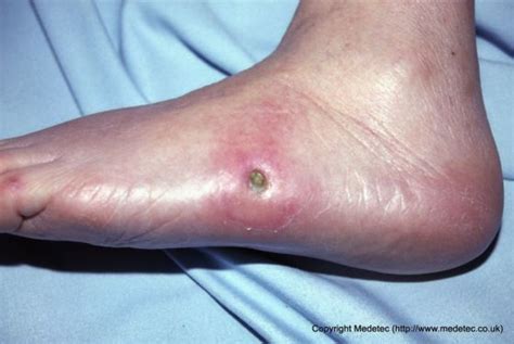 Diabetic Foot Ulcer Stages Pictures The Meta Pictures
