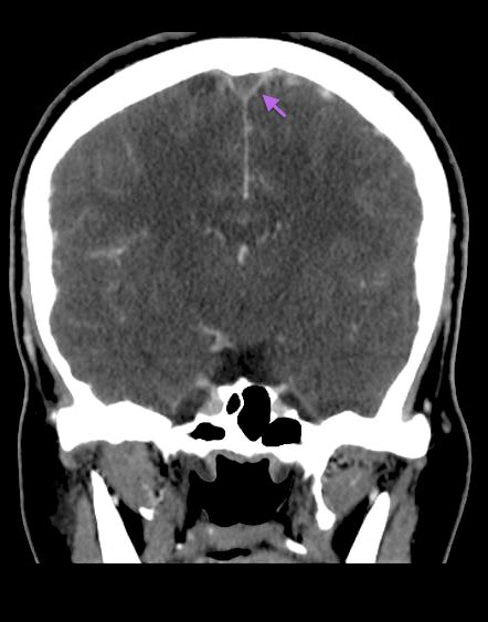 Empty Delta Sign Of Dural Venous Sinus Thrombosis Within The Superior