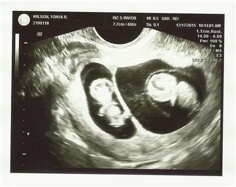 10 Weeks Pregnant Ultrasound Twins