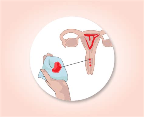 It should always be followed up, as it may be a sign of cancer. Signs and Symptoms | Uterine Cancers