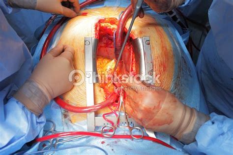 The Cardiac Surgery An Open Wound Stock Photo Thinkstock