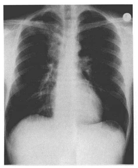 Chest Radiograph Showing Right Paratracheal Lymphadenopathy With