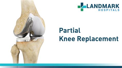 Partial Knee Replacement In Hyderabad By Dr Sudhir Kumar Reddy Landmark Hospitals