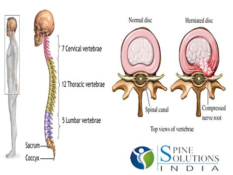 Spine Solutions India By Dr Sudeep Jain Disc Herniation