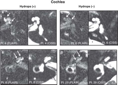 Hydrops Positive A And B And Hydrops Negative C And D Cochlea In
