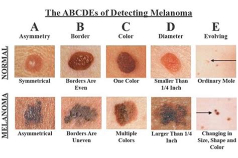 Early Signs Of Skin Cancer Kinds Of Skin Cancer