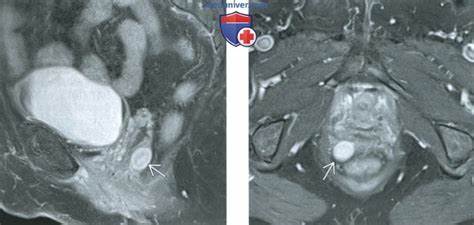 Диета при лейомиоме пищевода КТ, МРТ, УЗИ при лейомиоме влагалища КТ, МРТ, УЗИ при лейомиоме влагалища Диета при лейомиоме пищевода