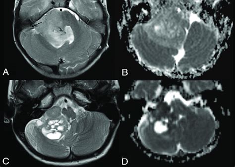 Differential Diagnoses In Posterior Fossa Tumors Involving The Foramen