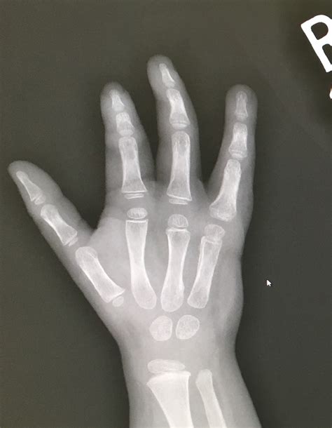 Unusual Extra Finger Congenital Hand And Arm Differences Washington University In St Louis