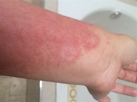 Urticaria Hives Going Beyond Coping