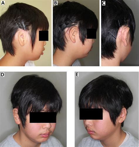 Posterior Auricular Artery Free Flap Reconstruction Of The