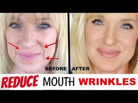 Smile lines occur due to the natural loss of volume that occurs in the face with age, mariwalla says. HOW TO GET RID OF DEEP MOUTH WRINKLES | HOW TO REDUCE AND ...