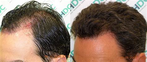 Side effects include, but are not limited to, nausea, vomiting, halitosis (bad breath), pain in the stomach, abdominal discomfort and a decreased libido, or sex drive. Fish Oil: Fish Oil For Hair Loss