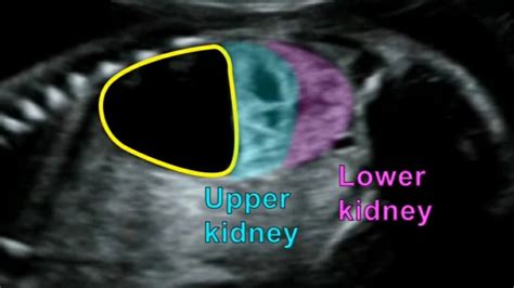 Urinoma Ultrasound Youtube