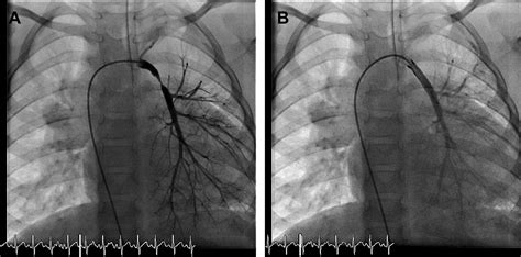 Stenting And Reimplanting Disconnected Pulmonary Artery In Tetralogy Of