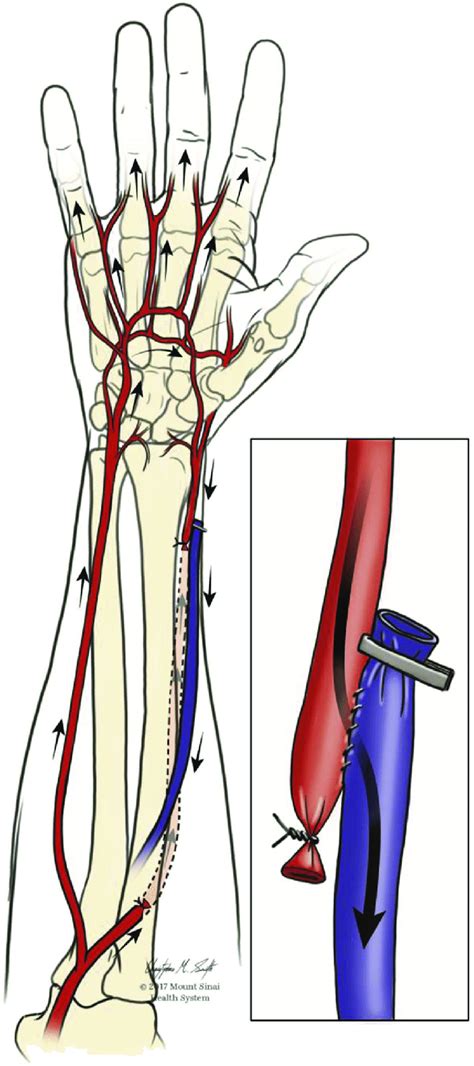 Fig Forearm And Hand Arterial And Venous Anatomy With The Autogenous