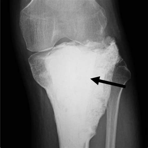 Radiography After Pmma Bone Cement Filling Following Allograft Chip