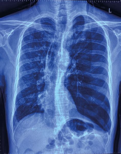 An Unusual Case Of Unilateral Hyperlucent Lung European Respiratory