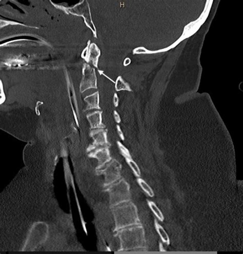Cureus Spinal Cord Transection In A Type Ii Odontoid Fracture From A