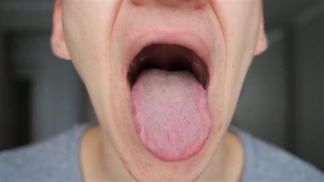 Wide Open Mouth Revealing Teeth Tongue Palate And Uvula