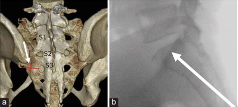 Percutaneous Sacroplasty For Sacral Insufficiency Fractures Case