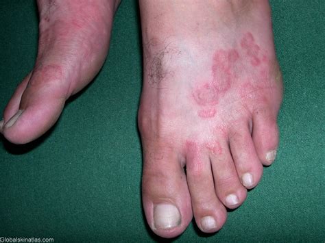 Fungal Infections Of The Skin Podiatry Hq