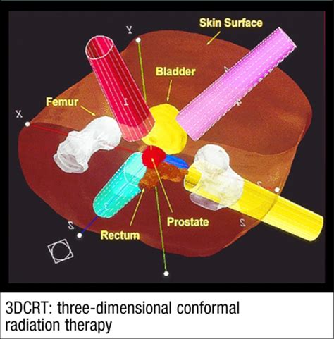 External Beam Radiation Therapy For Prostate Cancer Horwitz 2000
