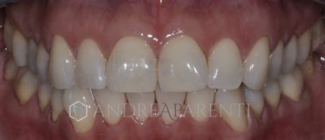Sbiancamento Dentale Studio Odontoiatrico Dr Andrea Parenti