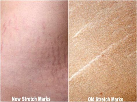 Can Tretinion And Hyaluronic Acid Fade Stretch Marks See What
