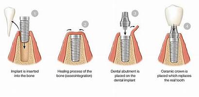 Implant Dental Implants Types Crown Stage Teeth