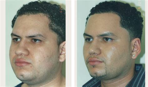 Buccal Fat Removal Before And After Cheek Bone Surgery